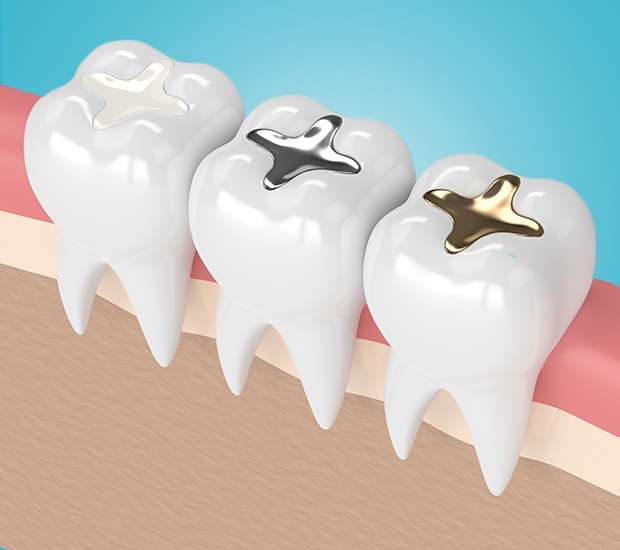 Brookshire Composite Fillings
