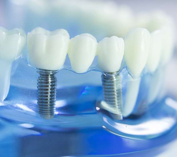 Brookshire Dental Implants
